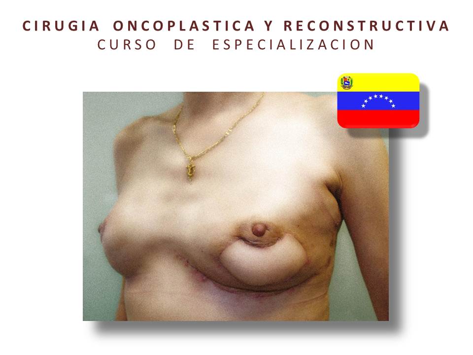 Curso de Oncoplastia y Reconstrucción Caracas 2013