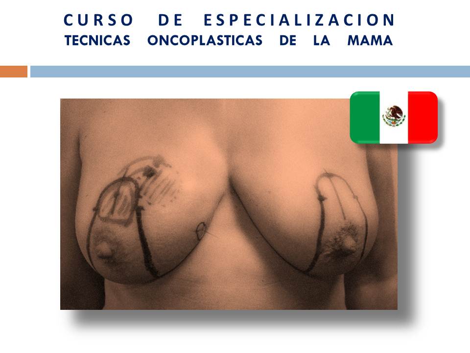 Programa Curso Oncoplastia México 2013